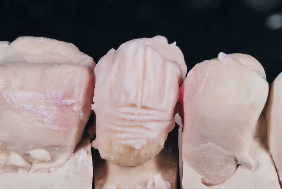 [2] Über den Chroma-Kern schichte ich die HeraCeram Dentine, die sehr lichtdurchlässig sind. Im Anschluss strukturiere ich die Massen mit ungleichmäßigen Rillen und Furchen. So scheint das Chromadentin mal stärker oder schwächer durch die Dentinschicht hindurch.