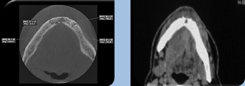 Abb. 2 u. 3: Visualisierung eines oralen Plattenepithelkarzinoms (OSCC) in der CT- und DVTGegenüberstellung; axiale Ansicht OSCC DVT/CT. (Drago B. Jelovac, Joerg Mudrak, Vitomir S. Konstantinovic, Svetlana Antic, Zvezdana Tepavcevic, Melvil Sabani. Diagnostic accuracy of CBCT in comparison to conventional imaging technique for the assessment of bone invasion by tumour in maxillofacial region. In Press).