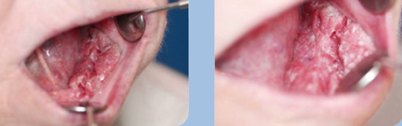 Abb. 2 u. 3: Intraoraler klinischer Status.