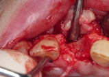 Abb. 3: Darstellung des Alveolarkamms mit Mukoperiostlappen.