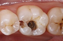 Abb. 2: Eröffnung des kompletten kariösen Defekts.