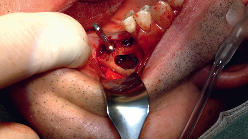 Abb. 2: Inserierter Prüfkörper und ISQ-Messung (Implantatstabilität).