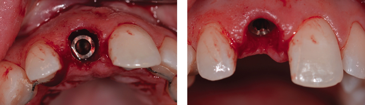 Abb. 4 u. 5: Implantatposition im ästhetischen Fenster und ohne vertikale Inzision für einen optimalen Erhalt der Papillen ohne Narbengewebe.