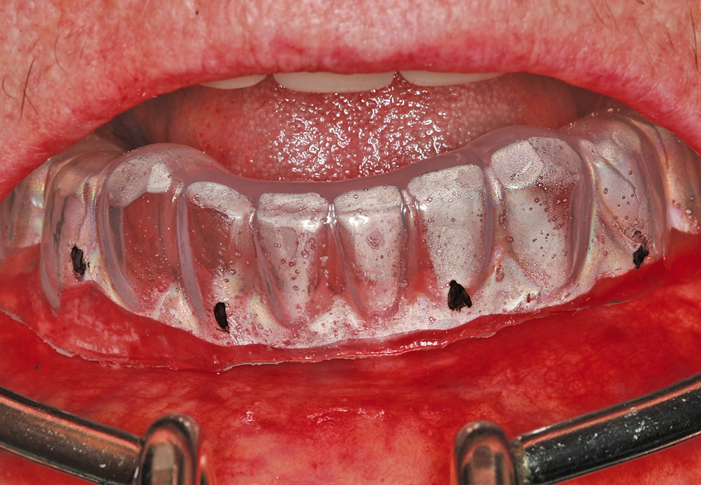 Abb. 2: Tiefziehschiene der vorhandenen Prothese zur Bestimmung der Implantatpositionen.