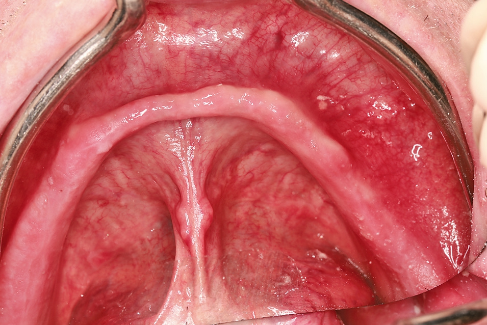Abb. 2: Ausgangsbild Schleimhautsituation im Unterkiefer.