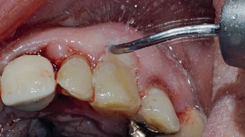Abb. 2: Spraynebelrückprall intraoral bei Anwendung eines Schallscalers (KaVo Dental, Biberach/Riß) subgingival in regio 23 im Rahmen eines Deep Scalings.
