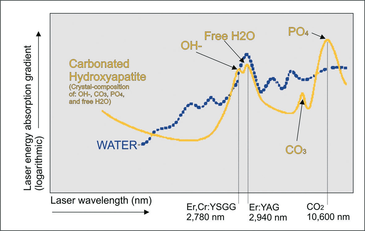 Abb. 2: Wasser- und Hydroxylapatit-Absorptionskurve für die in der Oral- und Kieferchirurgie gebräuchlichen Lasersysteme (Er,Cr:YSGG, Er:YAG, CO2). Abhängig von der unsichtbaren Infrarot-Lichtwellenlänge der einzelnen Lasertypen verhalten sich die resultierenden Laserlichtstrahlen unterschiedlich auf kalzifiziertes Gewebe. Die Er:YAG-Laserlichtwellenlänge besitzt einen hohen Wasser- und HA-Absorptionskoeffizienten, der pro Laserpuls nur eine sehr geringe Eindringtiefe in den Knochen zulässt, während der CO2-Laser einen geringeren Wasseraber höheren HA-Absorptionskoeffizienten vorweist, der pro Laserpuls ein etwas effektiveres Knochenschneiden zulässt.