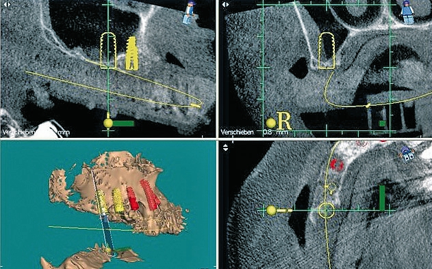 Abb. 2: Die dreidimensionale Darstellung des Sinus im DVT mit Simulation der geplanten Implantate.