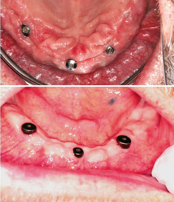 Abb. 2 und 3: Die postoperative Einheilung und die Nahtentfernung verliefen komplikationsfrei.