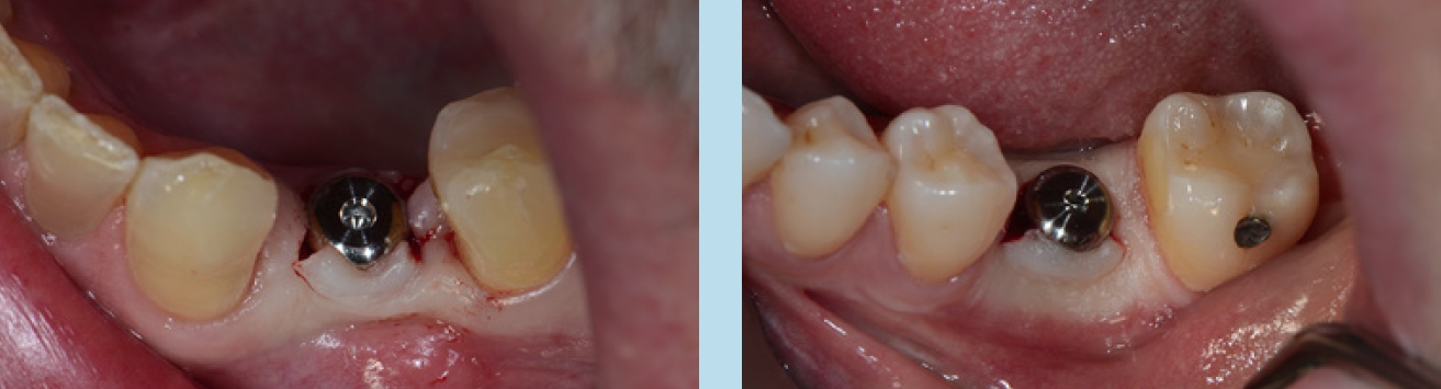 Abb. 1 u. 2: Freilegen mittels Stichinzision und Verdrängen der Schleimhaut unter Verwendung breiter Gingivaformer.