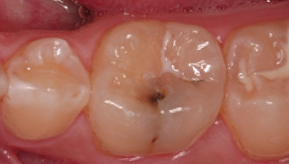 Abb. 1b: Der gleiche Zahn nach 19 Jahren nicht invasiver, präventiver Therapie. Mittlerweile imponiert eine Kavitation mit gräulichem Dentinschatten (ICDAS 5).