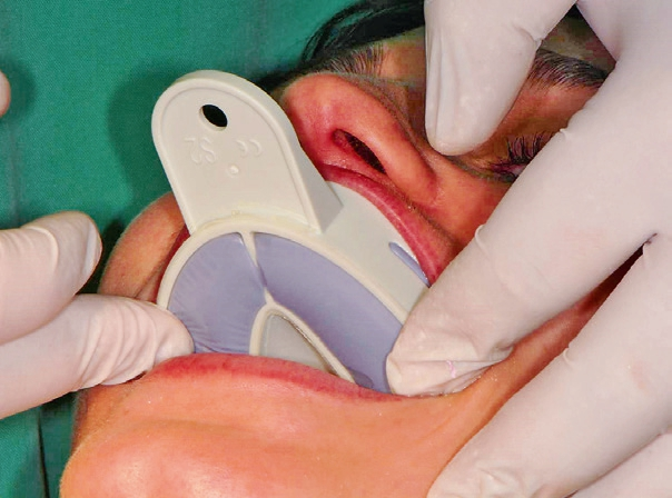 Abb. 2: Implantatabdruck regio 26 bei Zustand nach Implantation vier Monate zuvor.