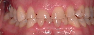 Abb. 2: Klinisches Bild massiver bimaxillärer Attritionen.