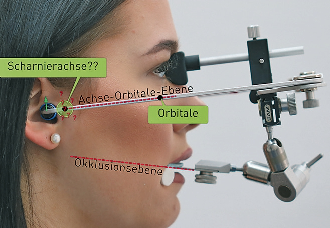 Abb. 2: Korrekt angelegter anatomischer Transferbogen („Gesichtsbogen“). Nur in etwa der Hälfte der Fälle liegt die tatsächliche Scharnierachse innerhalb eines Kreises von 5 mm Radius (grün) um den arbiträren Achsenpunkt.