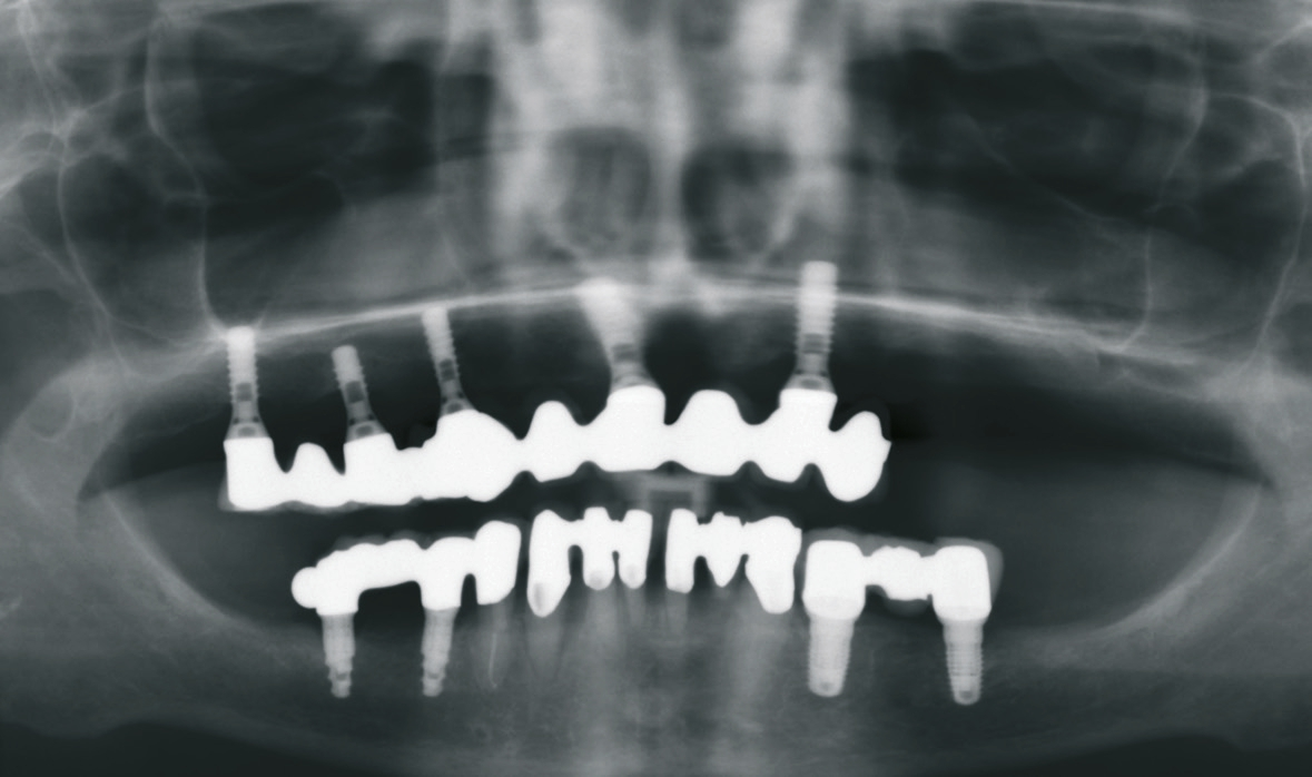 Abb. 2: OPG drei Monate nach Entnahme der alten Implantate.