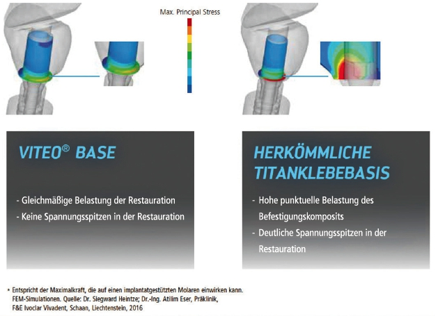 Abb. 2: Vergleich verschiedener Designs von Titanklebebasen bei einer Krafteinleitung von 300 N.
