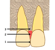 Abb. 1: Definition des Approximalraums: 1) Approximalfläche-Kontaktfläche, 2) Gingiva, 3) Alveolarknochen.