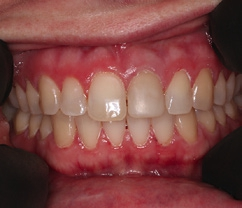 Abb. 2: Ausgangssituation. Zahn 21 zeigte eine marginale Rötung der Gingiva, die bei Sondierung blutete.