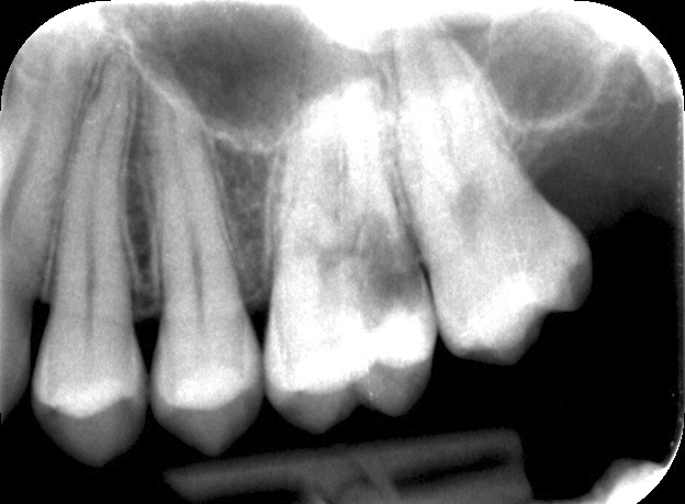 Abb. 2: Die röntgenologische Darstellung von 26 vor Extraktion zeigt Zeichen einer Wurzelresorption.