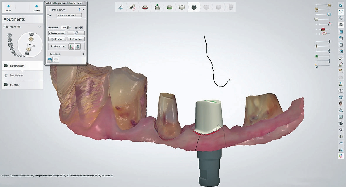 Abb. 2a: Beispielhafte Konstruktion eines individuellen Abutments auf Camlog-Implantat.