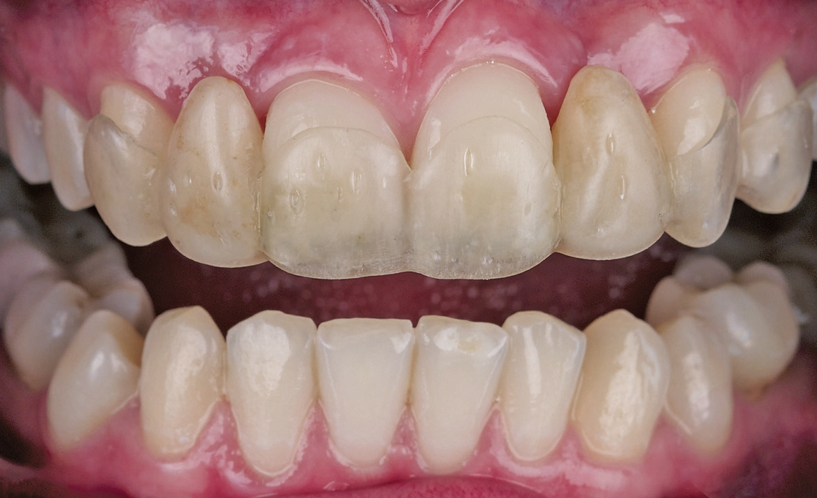 Abb. 2: Schiene als Platzhalter an 12 und 22.