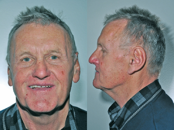 Abb. 2a u. b: Patient mit alter Prothese.