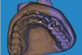 Abb. 2: Prothetische Ausrichtung der Implantate in der Planungssoftware.
