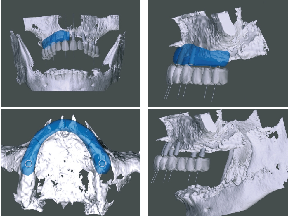 Abb. 3 bis 6: Patientenspezifische Planung der allogenen Transplantate am virtuellen Modell des Oberkiefers.
