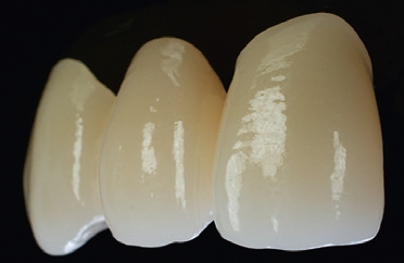 Abb. 2: Monolithische Brücke aus Zirkoniumdioxid mit integriertem Farbverlauf – unbeschichtet und unbemalt, nur Glanzbrand.