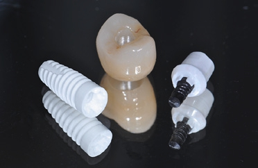 Abb. 2: Das Implantatsystem NobelPearl mit karbonfaserverstärkten Vicarbo-Schraube.