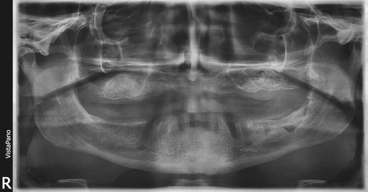 Abb. 2: OPG nach externem Sinuslift beidseitig mit Eigenknochenentnahme an den Tubera und Kieferwinkel links.