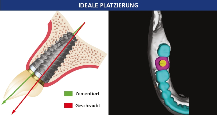 Abb. 1c: Im anterioren Bereich sollte das Implantat leicht lingual in Richtung Inzisalkante ausgerichtet werden, um eine zementierte Krone (grün) einzusetzen. Für eine anteriore verschraubte Restauration sollte das Implantat in Richtung Höckerbereich (rot) ausgerichtet sein. Abb. 1d: Im posterioren Bereich richtet sich die ideale Implantatposition an der Fossa der Nachbarzähne aus.