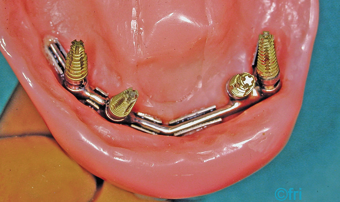 Abb. 2: Schlupfwinkel unter einer Unterkieferprothese, die über einen Implantat getragenen Steg abgestützt ist.