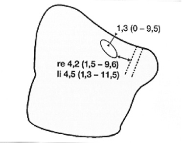 Abb. 2: Schematische Darstellung der Lokalisation des Ostium maxillare im Bereich der rechten medialen Kieferhöhlenwand. Unterbrochene Linien markieren die Lage des Tränennasenganges.