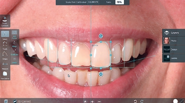 Abb. 2: Ausgangsbefund und virtuelle Planung von inzisal ineffizienten Frontzähnen nach dem Prinzip des Digital Smile Designs (DSD).