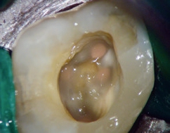 Hier spielt die SDR-Technologie ihre Stärken aus: Infolge einer endodontischen Behandlung wird eine Kavität mit hohem C-Faktor mithilfe der Bulkfill-Technik versorgt.