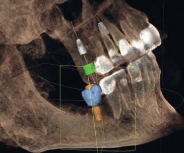 Abb. 2: Screenshot DVT-Planung.