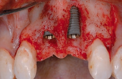 Abb. 2: Nach der Implantatinsertion war ein kleiner Dehiszenzdefekt zu sehen und eine große bukkale Knochendehiszenz lag vor.