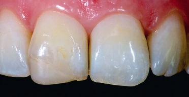 Abb. 2: Eine deutliche farbliche Diskrepanz ist zu erkennen.