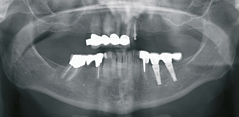 Abb. 2: Orthopantomografi e des Anfangsbefundes.