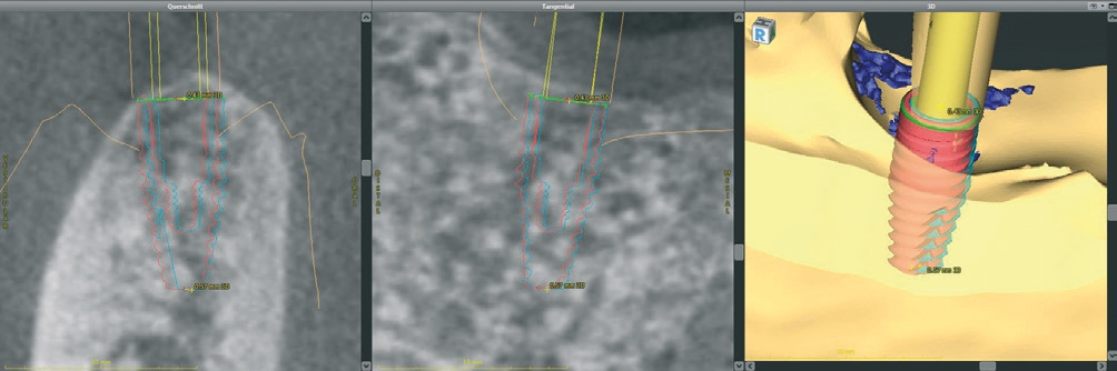 Abb. 3: Postoperative Evaluation der erreichten Implantatposition mittels Scanpfosten und 3D-Scandaten (coDiagnostiX 9.12, Dental Wings).