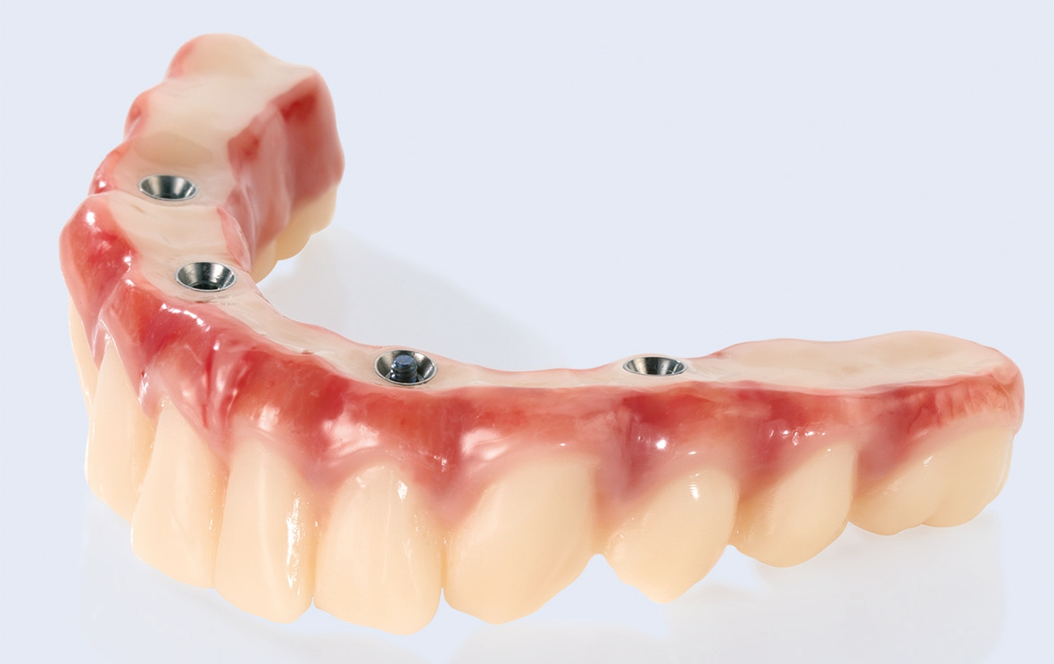 Ceramill A-Temp: Implantatgetragene (REAX-)Brücke, Gingiva verblendet.