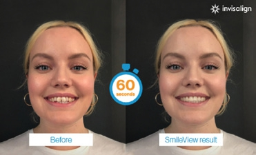 SmileView – Online-Tool simuliert Zahnkorrektur.