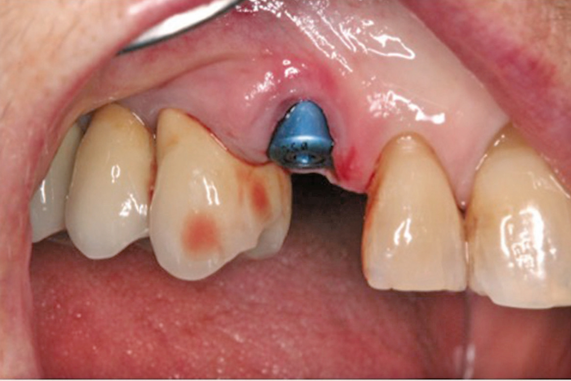 Abb. 2: Healing-Abutment nach der Sofortimplantation (OsseoSpeed Profile EV, PS 4.8) in regio 13.