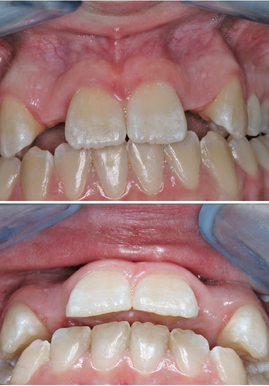 Abb. 2 und 3: Ausgeprägte horizontale Alveolarfortsatzatrophie in regio 12 und 22 mit ausgeprägten Konkavitäten in der bukkalen Lamelle.