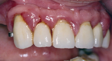 Abb. 2: Ausgeprägte superinfizierte Gingivahyperplasie durch Amlodipin.