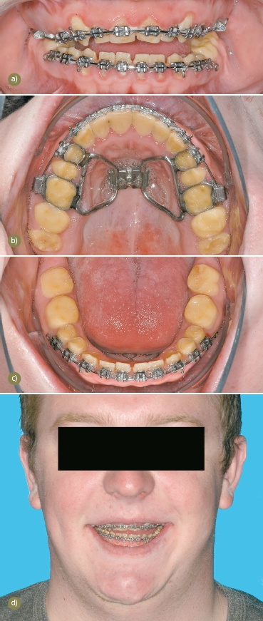 Abb. 2: Zustand nach chirurgischer Gaumennahterweiterung, Entfernung der Zähne 38 und 48 und Eingliederung der kieferorthopädischen Apparatur. a) Frontale Ansicht nach Einbringen des Multibandes im Ober- und Unterkiefer. Antagonistischer Kontakt bestand nur im Molarenbereich bei frontal offenem Biss. b) Aufsicht Oberkiefer mit Gaumennahterweiterungsapparatur und Multiband zur Ausformung der Zahnbögen. c) Aufsicht Unterkiefer mit Multiband zur kieferorthopädischen Ausformung des Zahnbogens. d) In der frontalen Ansicht wird auch deutlich, dass der Patient die Zunge zwischen die Zahnreihen des Ober- und Unterkiefers positioniert.