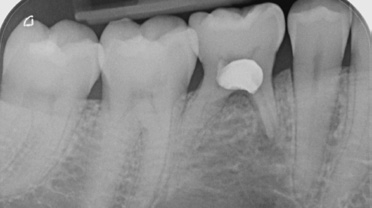 Abb. 2: Beginnende Funktion sowie apikale Ostitis des Zahns 85, Foramen mentale in der intraoralen Röntgenaufnahme.