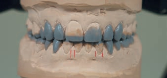 Abb. 2: Wax-up mit funktionskorrigierenden Repositions-Onlays und Full-Wrap 360° Repositions-Veneers.