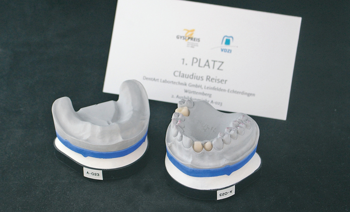 Abb. 2: Modellpaar. Unterkiefer: umfunktioniertes Funktionsmodell, Oberkiefer: Alveolenmodell mit Kunststoffstümpfen.